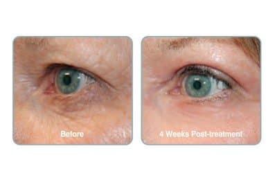 6 Solutions for the Eye area at The Private Clinic Swansea