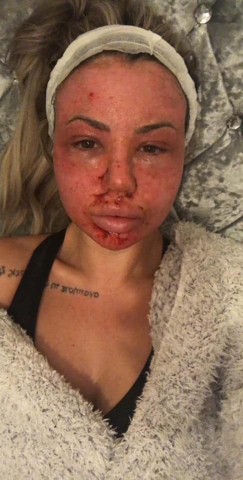 Holly Hagan After CO2 Laser Facial