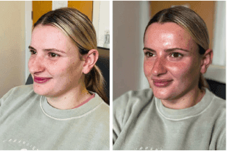 before and after hydrafacial the grove skin and laser clinic