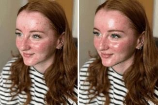 hydrafacial before and after