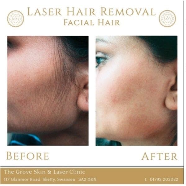 before and after facial laser hair removal